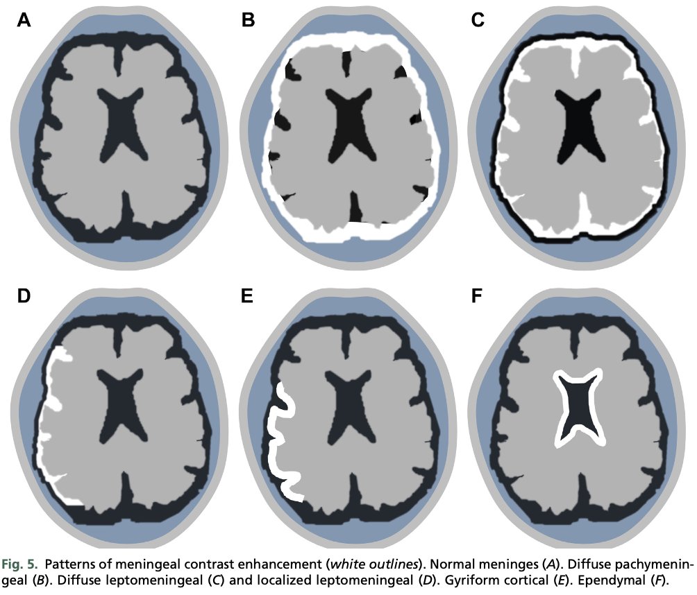 CarlosJMoreno_'s tweet photo. #Review #ID #Neurology 
Neuroimaging Patterns of Intracranial Infections.
Neuroimag Clin N Am 33 (2023) 11–41. DOI: 10.1016/j.nic.2022.07.001 https://t.co/Kbt1unUTPd