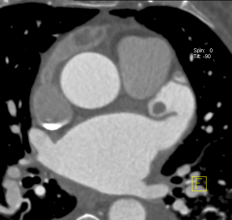 Stephan Achenbach (@steph_achenbach) on Twitter photo Cardiac CT: Thrombus in a very angulated/flexed left atrial appendage
#Cardiotwitter <a href="/escardio/">European Society of Cardiology</a> <a href="/Drroxmehran/">Dr Roxana Mehran</a> <a href="/DrRumberger/">Dr. John A Rumberger, PhD, MD, FACC, MSCCT</a> <a href="/mirvatalasnag/">MIЯVΛƬ #IC</a> <a href="/M_Ijgua/">Mohamed Cherif Ijgua</a> <a href="/M_Marwan_/">Mohamed Marwan</a> <a href="/CardiacCTGuy/">Maros Ferencik</a> <a href="/SuhnyAbbara/">Suhny Abbara MD</a> <a href="/cury_ricardo/">Ricardo C. Cury, MD</a> <a href="/RonBlankstein/">Ron Blankstein</a> <a href="/ToddVillinesMD/">Dr. Todd C. Villines</a> <a href="/Heart_SCCT/">Heart_SCCT</a> <a href="/RadiologyCTI/">Radiology: Cardiothoracic Imaging</a> #radiology Cardiac CT: Thrombus in a very angulated/flexed left atrial appendage
#Cardiotwitter <a href="/escardio/">European Society of Cardiology</a> <a href="/Drroxmehran/">Dr Roxana Mehran</a> <a href="/DrRumberger/">Dr. John A Rumberger, PhD, MD, FACC, MSCCT</a> <a href="/mirvatalasnag/">MIЯVΛƬ #IC</a> <a href="/M_Ijgua/">Mohamed Cherif Ijgua</a> <a href="/M_Marwan_/">Mohamed Marwan</a> <a href="/CardiacCTGuy/">Maros Ferencik</a> <a href="/SuhnyAbbara/">Suhny Abbara MD</a> <a href="/cury_ricardo/">Ricardo C. Cury, MD</a> <a href="/RonBlankstein/">Ron Blankstein</a> <a href="/ToddVillinesMD/">Dr. Todd C. Villines</a> <a href="/Heart_SCCT/">Heart_SCCT</a> <a href="/RadiologyCTI/">Radiology: Cardiothoracic Imaging</a> #radiology