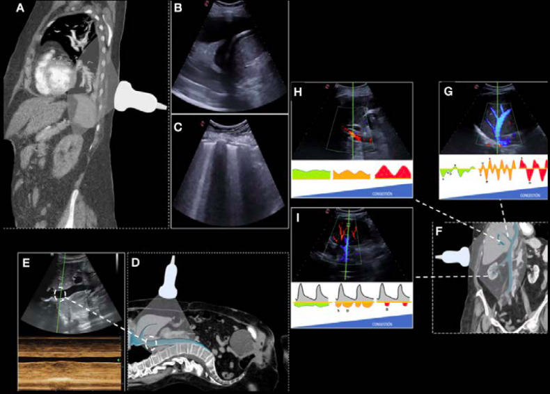 yaletung's tweet photo. Systemic Venous #POCUS in #HeartFailure @200julios

☠️Mortality
1️⃣Intrarenal monophasic (AUC 0.923)
2️⃣ #VExUS score 3 (AUC 0.885)
3️⃣Portal >50% (AUC 0.749) 
4️⃣Needless repeat scan 🛌

🏥Readmission
1️⃣Intrarenal monophasic (AUC 0.834)
2️⃣IVC >2cm (AUC0.758)

https://t.co/5IuIfcVqX3 https://t.co/riL02s6LnO