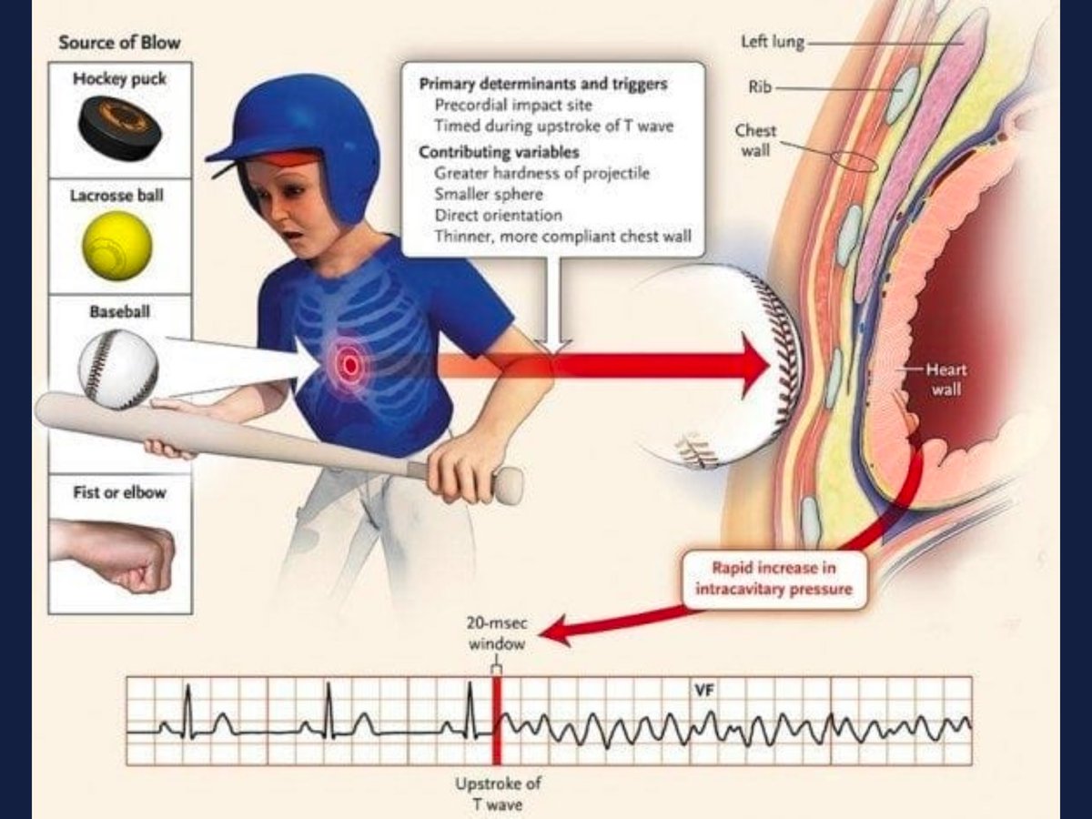 As a physician I believe Damar Hamlin was likely suffering from commotio cordis where a blow to the chest at a precise moment in the electrical cycle stops the heart. Those trying to tie this to vaccine status to project their unscientific beliefs are terrible, horrible people.