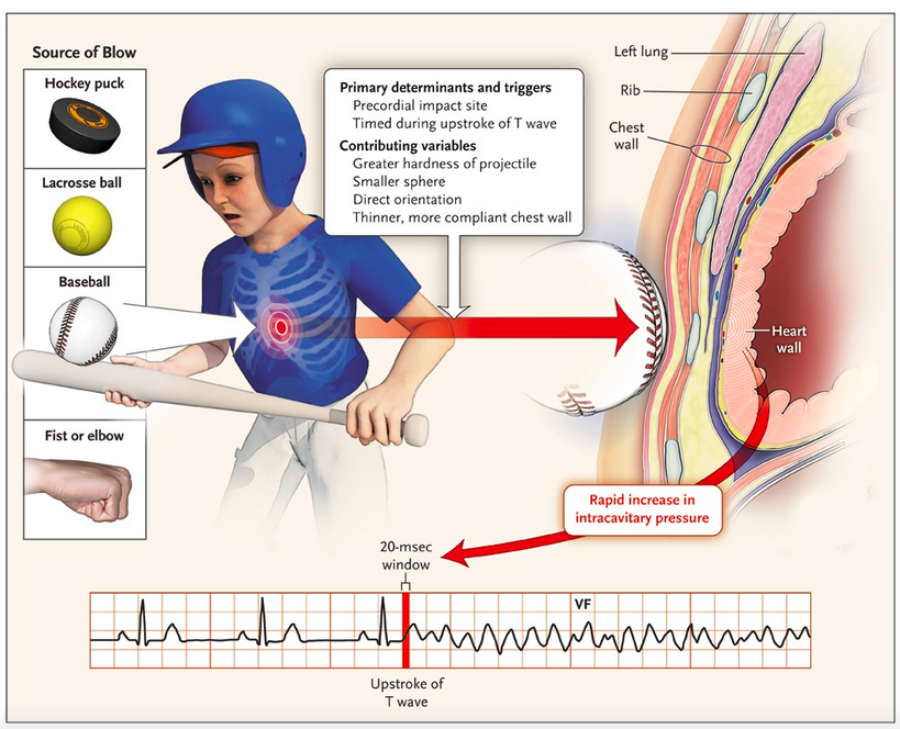 marklewismd's tweet photo. The Damar Hamlin collapse looked a lot like commotio cordis, the exact wrong moment of impact creating an electrical impulse that results in arrhythmia

It is described in many contact sports 

Survival rates have been rising with better CPR/AED availability but it is often fatal https://t.co/C3roHSvK2V