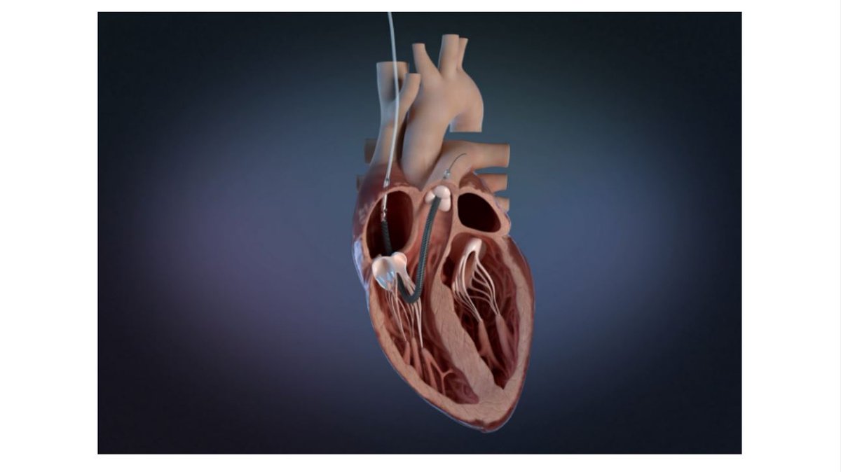 #Impella RP Flex with #SmartAssist receives #FDA pre-market approval | #FreeAccess👇
bit.ly/3vBpitD
@JasonHanMD #Pump #RecentNews