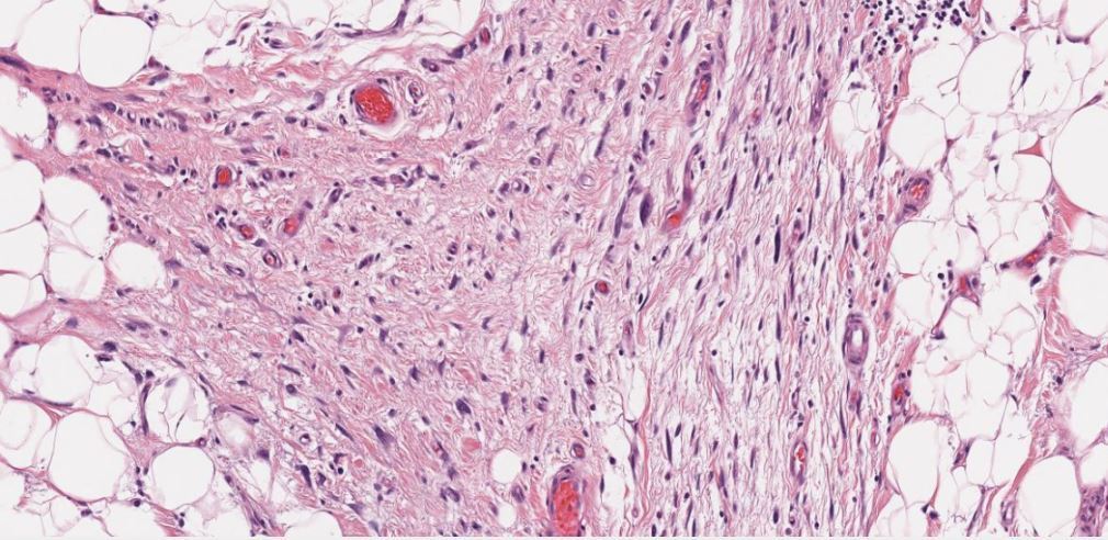 Deep soft tissue tumor ❓Diagnosis ⚠ A PITFALL involving this tumor #bstpath #pathology