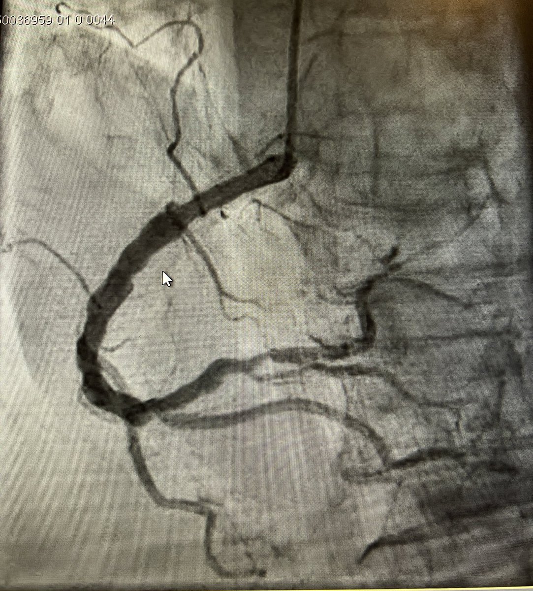 gregoirerange's tweet photo. Nstemi 85 F, 40%LVEF, EKG : ASA neg T, ETT apical akinésie. How do you manage this LM nightmare ? https://t.co/xMxe4kYDGc
