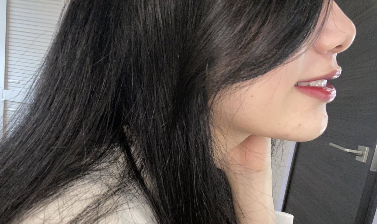 顎変形症、矯正の経過（？）
横顔のまとめ

一枚目　　手術前
二枚目　　術直後（腫れと器具あり）
三.四枚目　術後、器具なし

再掲すみません！
手術前の横顔写真は本当に無くてレアなのでどうせなら載っけます！