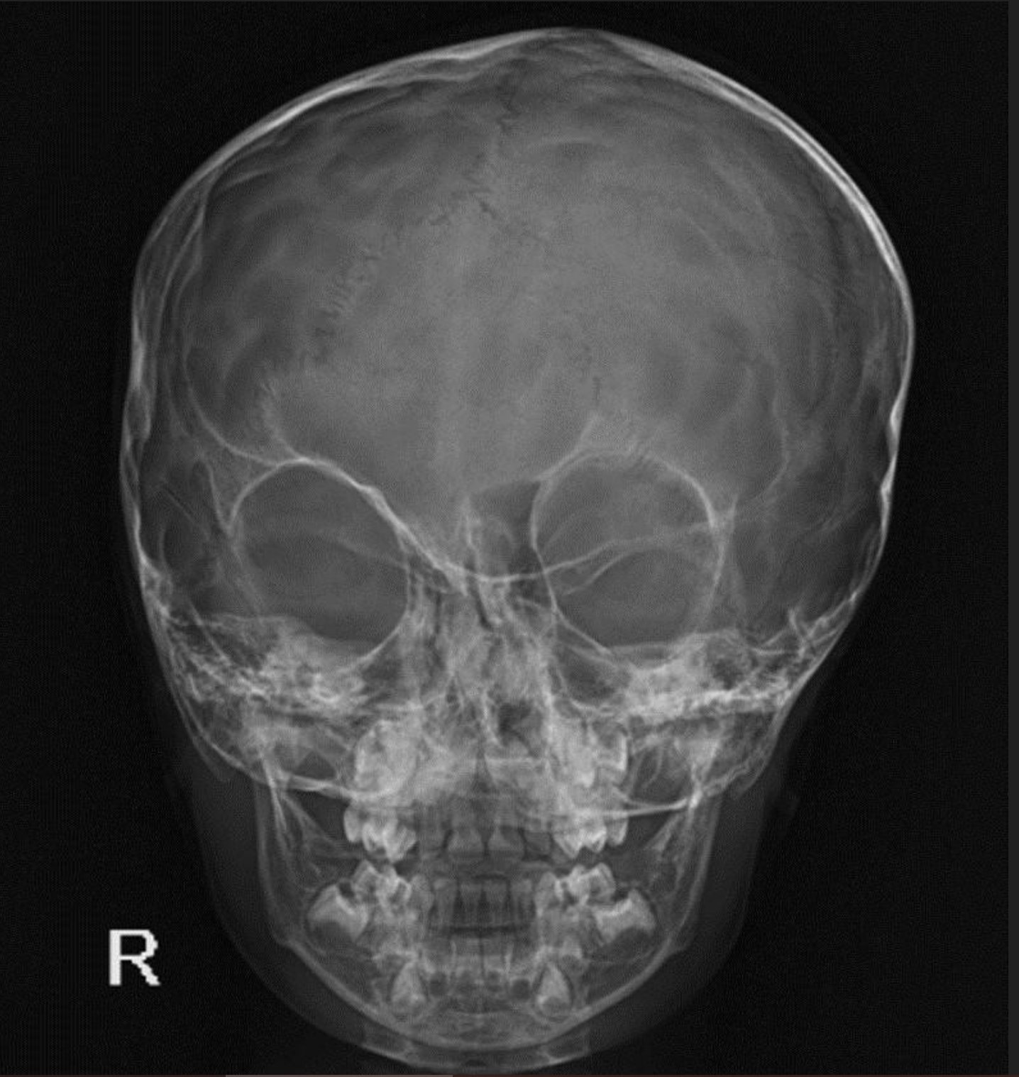 myesr على X: "New Year, new EuroRad case! 🎆 ➡ A 4-year-old male with  history of abnormal morphology of head and behavioural abnormalities.  Normal birth. What diagnosis would you give? A) Dolichocephaly