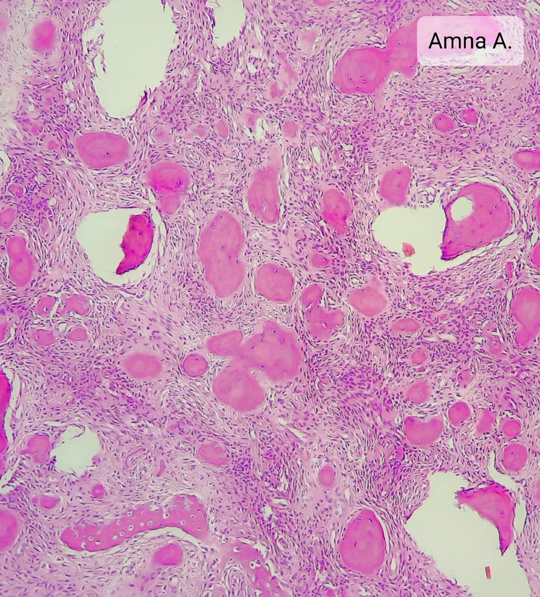 First case of 2023.🥳🥳 35 years female swelling over right maxillary region. 😯 What am I? 🤔 #TwitterPath #PathTwitter #OralPathology #MedTwitter