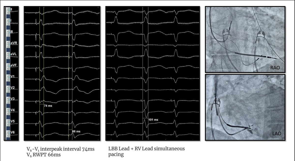 ipetemil's tweet photo. LBB Pacing in a HF patient with LBBB and prior unsuccessful CS Lead implantation.  @vlachoskonstan1 @K_Letsas LampropoulosGeorge @BellosPeriklis PuliouniDimitra @MEfraimidis #onassiscardiacsurgerycentre #EnSiteX #3830lead #dontdistheLBB https://t.co/6bF2vTN9hd