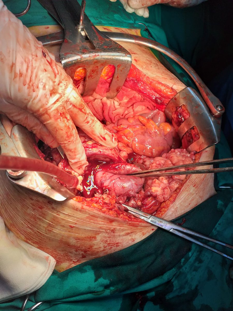 MdSinziana's tweet photo. Different intraop aspects of peritoneal carcinomatosis from ovarian tumors #surgery #carcinomatosis #peritoneum #Cancer #ovariancancer #surgeon @CancerGrand @NCIResearchCtr @CancerResearch @EuropeanCancer @SurgeryScience @OCNA @OvarianCancerUK @TargetOvarian @OvarianCancerDY https://t.co/rySXRkkOgP