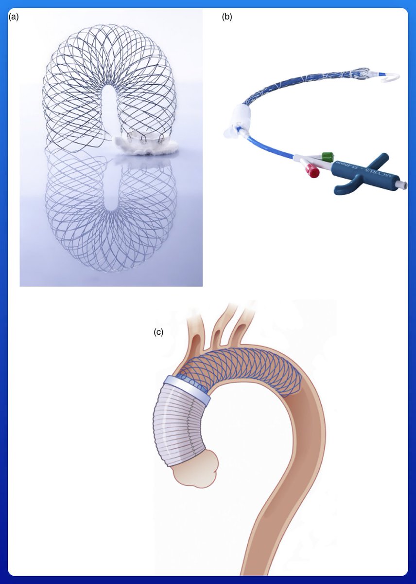 Thoraflex Hybrid vs. AMDS: To replace the arch or to stent it in type A aortic dissectio

journals.sagepub.com/doi/10.1177/02…