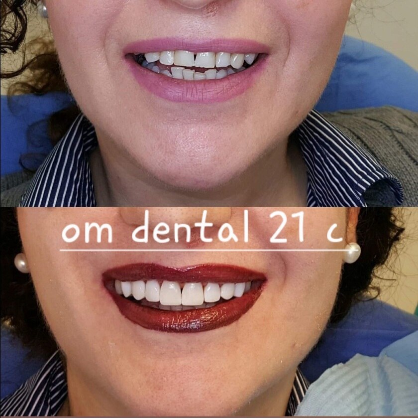 OMDENTALCLINICS's tweet photo. Best dental clinic near you in sector 21 c faridabad for dental lami ..For more info visit...https://t.co/yv1fqCCIZ4 https://t.co/OHTVBmxhWd