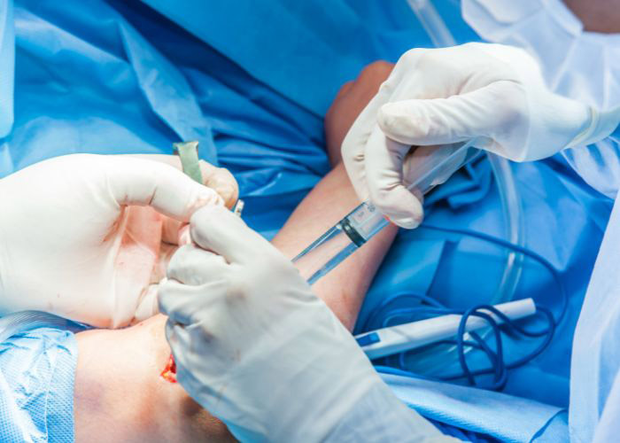 JosephLamplotMD's tweet image. If the patient’s #elbow #epicondylitis is severe, resulting from a torn tendon, or fails to be alleviated by conservative treatment options, this repair may be recommended to surgically fix the injury. Here is why: medilink.us/p89b  #orthotwitter