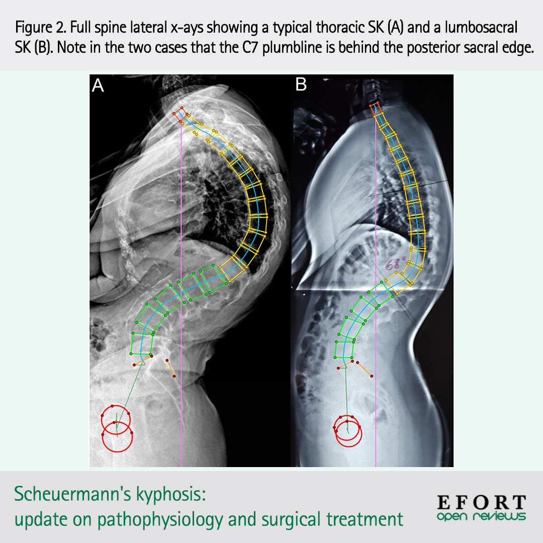 EFORTnet's tweet photo. #Scheuermann’s #Kyphosis: several theories have been proposed concerning its pathogenesis, but it is to this day still unknown. #OpenReviews study propose a #treatmentalgorithm for its management 📄 https://t.co/TsWHhst1c3 #spine #orthopaedics #orthopedics #openaccess #surgery https://t.co/iYZYsz2zMK