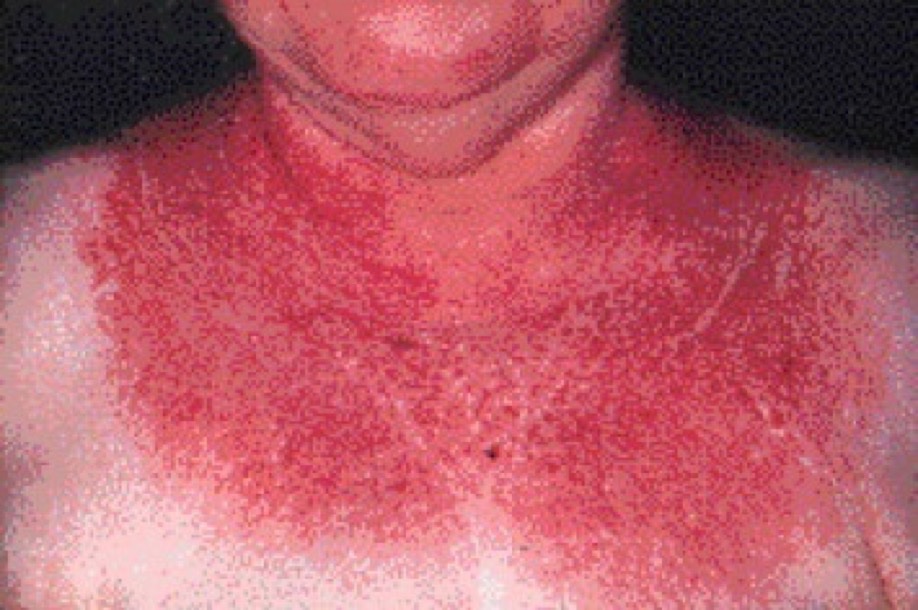 BrownJHM's tweet photo. A 65 year old man presents with weakness &amp; inability to walk up a flight of stairs. Exam revealed a hyperpigmented rash. What is the diagnosis? (image: lancet) #MedTwitter https://t.co/XRoMG6OqO9 https://t.co/yyvfbjpx9v