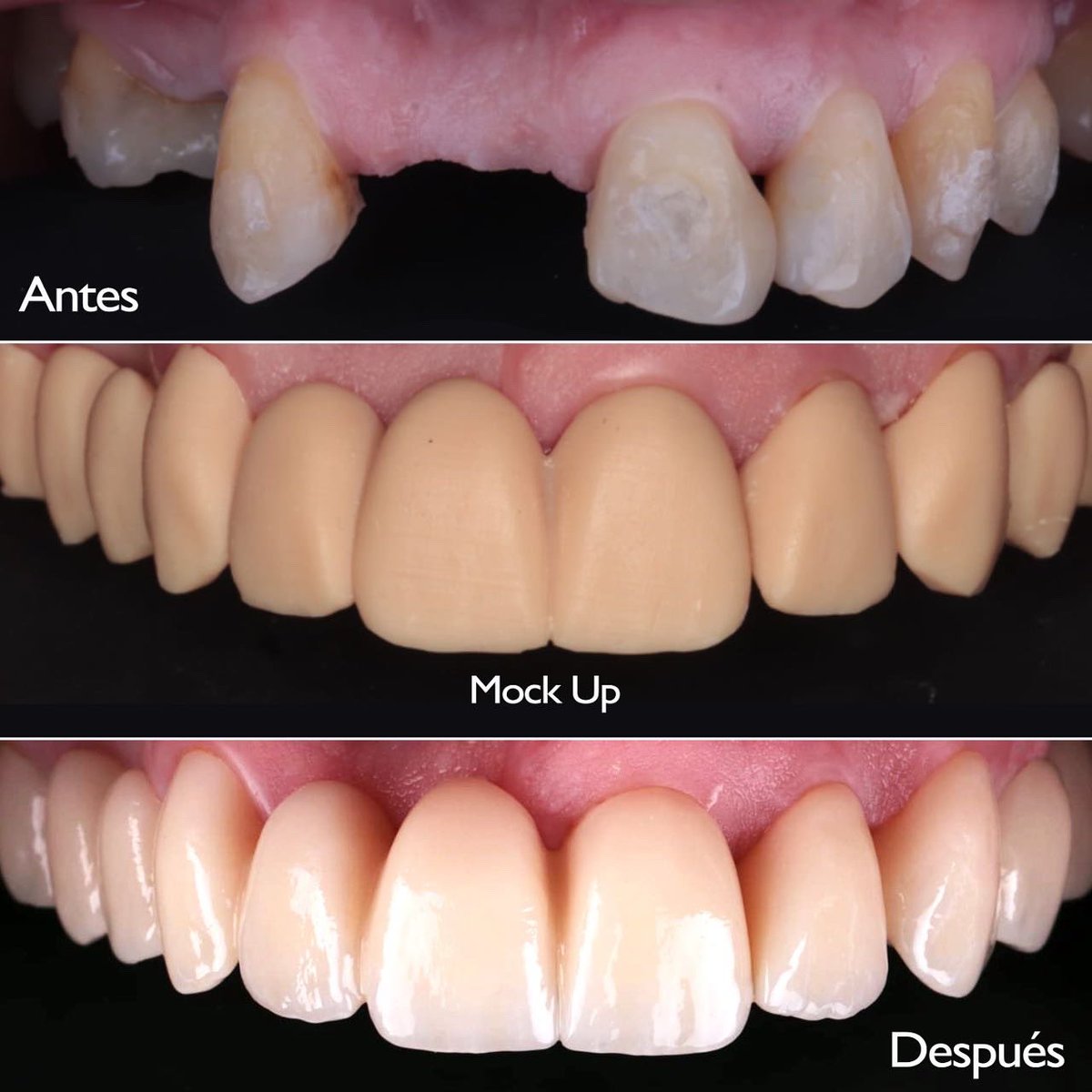 SmileFactorygt's tweet photo. Sonreír es disfrutar la vida, y nosotros te ayudamos a que tengas la sonrisa que siempre has querido. 

Caso: Puente Dental 

#guatemala #dentista #gt #guatetrending #odontologia #puentedental #guate #dientes #sonrisa https://t.co/txtQJy8AlB