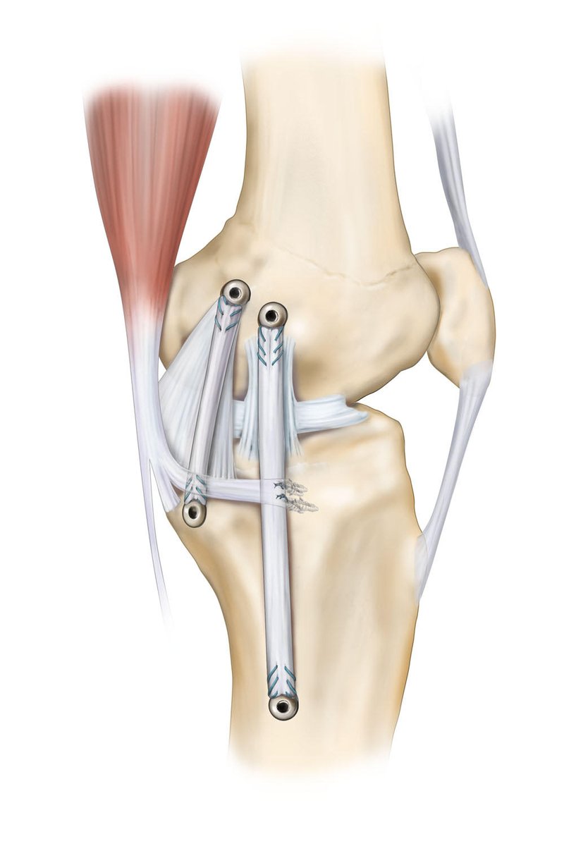 thekneedoc's tweet photo. #MCLinjuries in #soccer or #football have a common mechanism. Usually, this is because the #knee is hit on the outside and it puts extra stress on the inside and stresses the #MCL. In those circumstances https://t.co/PgD4scAqxJ https://t.co/MOlvVKke3p