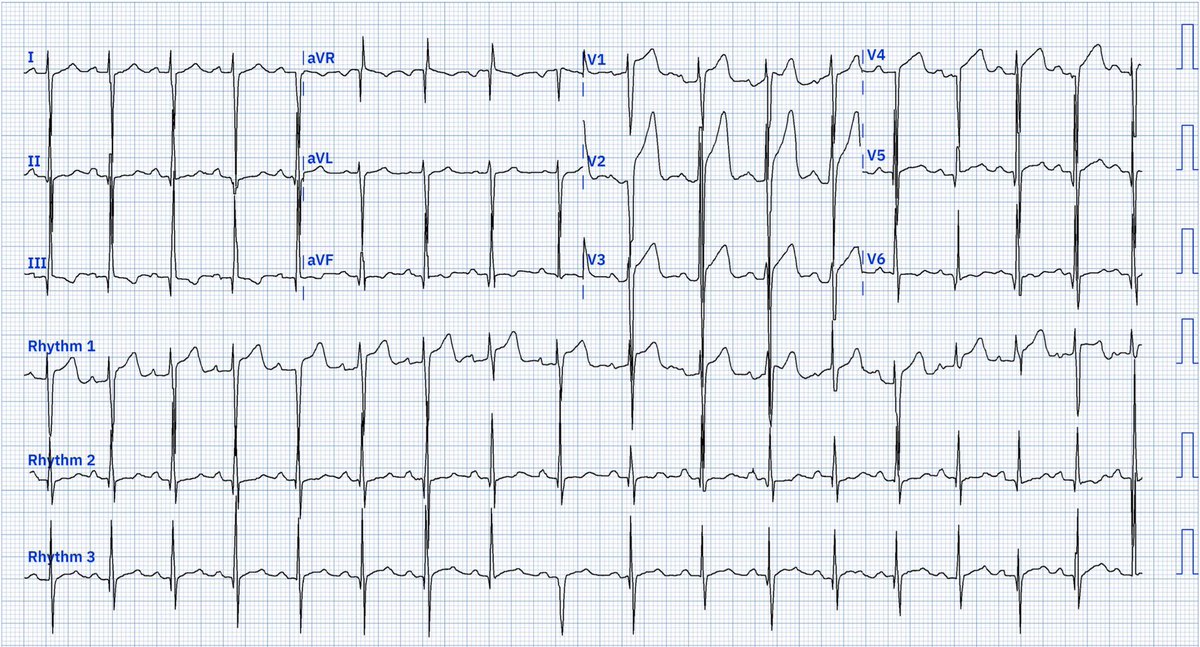 BansroVarinder's tweet photo. A 25 year old male came in with 1 week of exertional chest discomfort. @smithECGBlog @EM_RESUS @EkgHacks @EKGest                                             Ekg digitalised by @RobertHermanMD https://t.co/7etRsisaE4