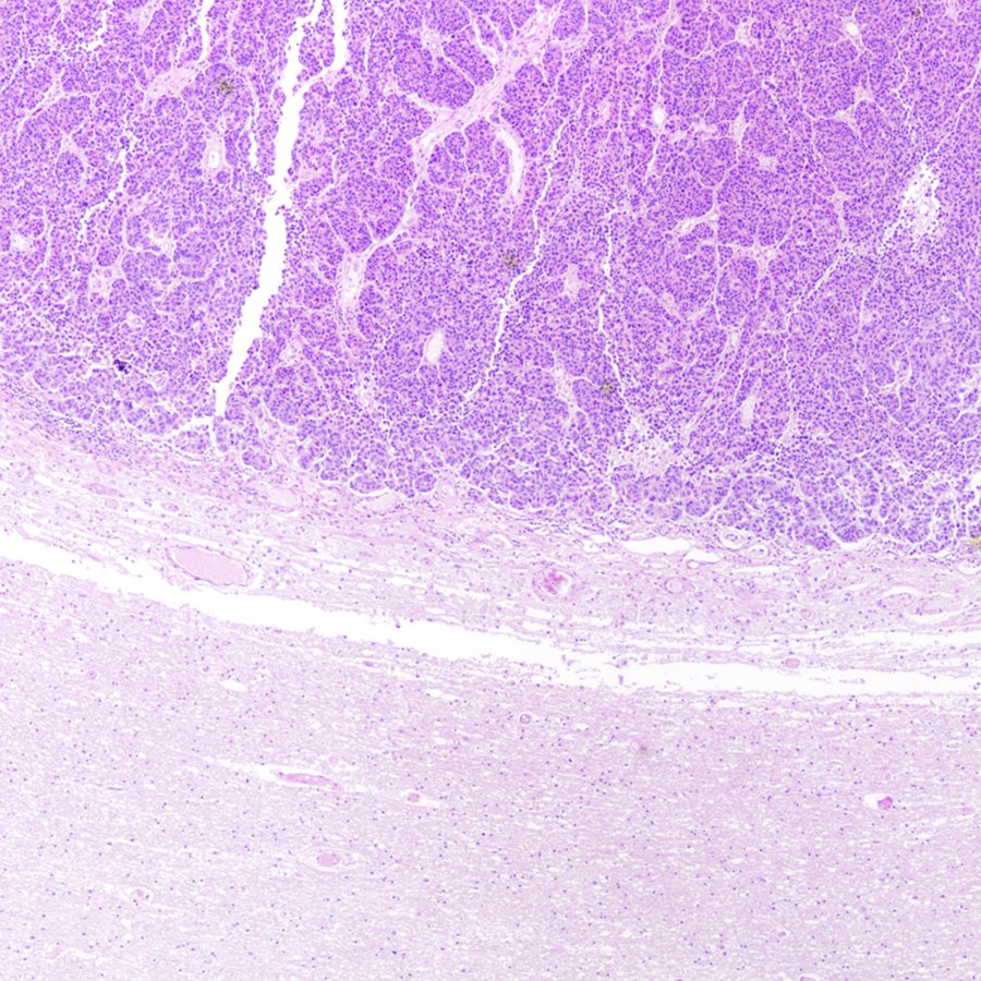 CraigHorbinski's tweet photo. First #neuropath tweet of 2023: postmortem case of a brain tumor in an older person that had never been operated on. Based on premortem history, differential was between #glioblastoma and metastatic #melanoma. Which one is correct? #pathology #PathTwitter https://t.co/bmvJQ4BVFw