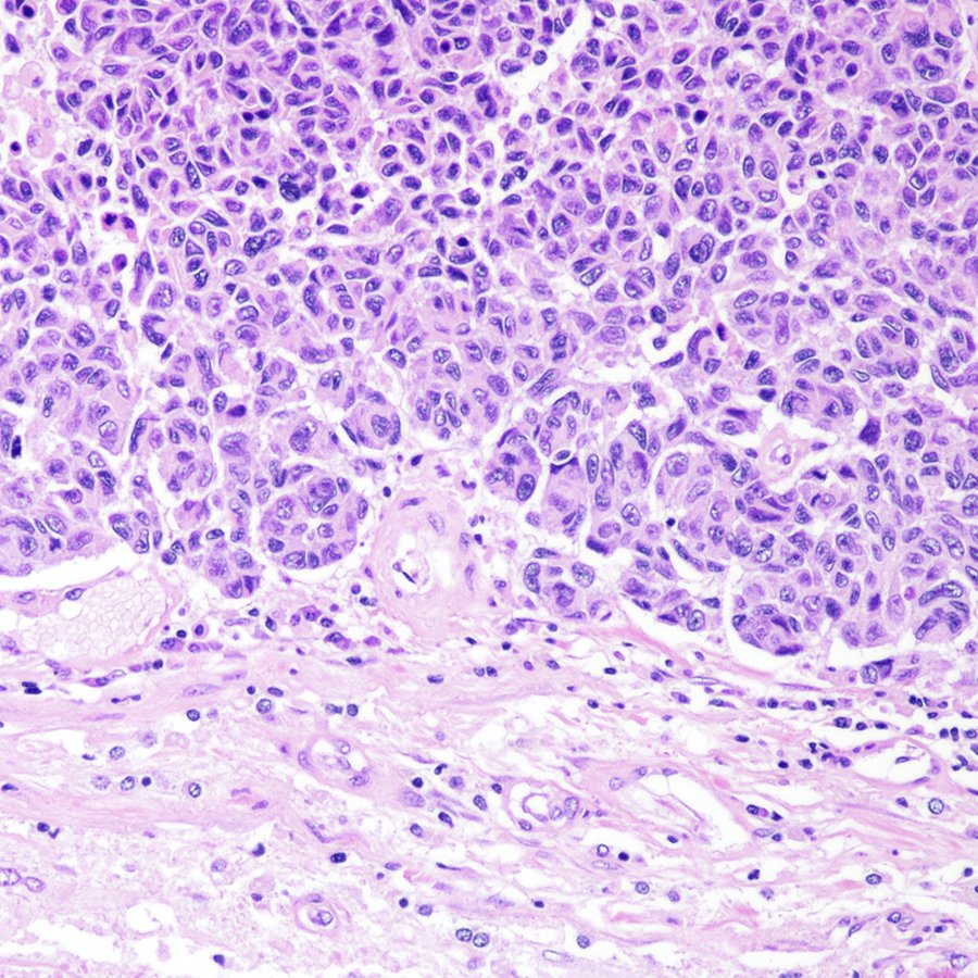 CraigHorbinski's tweet photo. First #neuropath tweet of 2023: postmortem case of a brain tumor in an older person that had never been operated on. Based on premortem history, differential was between #glioblastoma and metastatic #melanoma. Which one is correct? #pathology #PathTwitter https://t.co/bmvJQ4BVFw