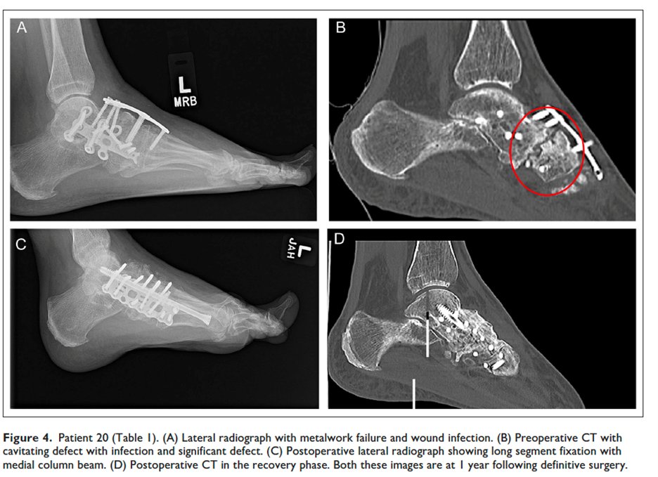 AOFAS_Journals on Twitter "This study with 30 infected foot/ankle non