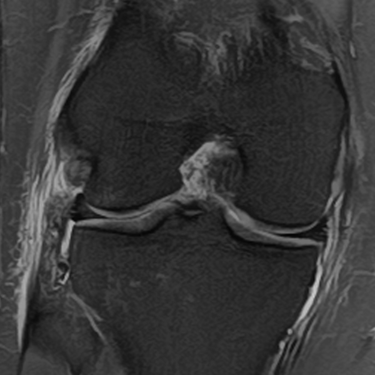 RadsourceLLC's tweet photo. In the first Radsource MRI Web Clinic of 2023, Dr. Leon Toye discusses anatomy and pathology relevant to a lesser-known knee structure frequently injured in association with ACL tears. #radiology #mri #kneepain

https://t.co/lcjILRB1zI https://t.co/VMoiTJ7foi