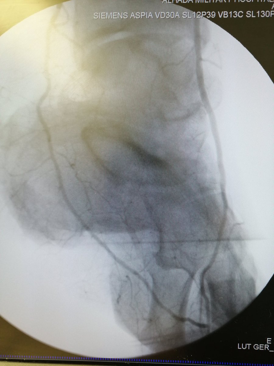 Non healing heel ulcer treated by pedal arch revascularization #pedal #plantarloop 

@AshourMD @zerghamzia  @bentawalah @MoonJustaniah @SIRspecialists @sirs_ksa @SIRRFS @drmcumming @vascularIR
@_AzizAhmad_

#IRad #Radres #SIR #VIR #PAD #MedEd #MedTwitter #PADawareness #CLIFighter