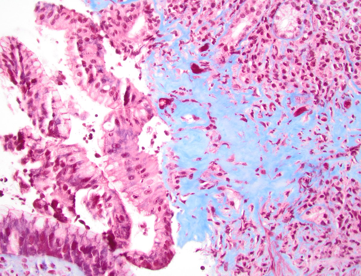 dgbrackett's tweet photo. 🟦Collagenous gastritis
🟦Trichrome stain highlights the thickened subepipthelial collagen w/ entrapped inflammatory cells &amp; capillaries
#GIpath https://t.co/cPGy598aZV