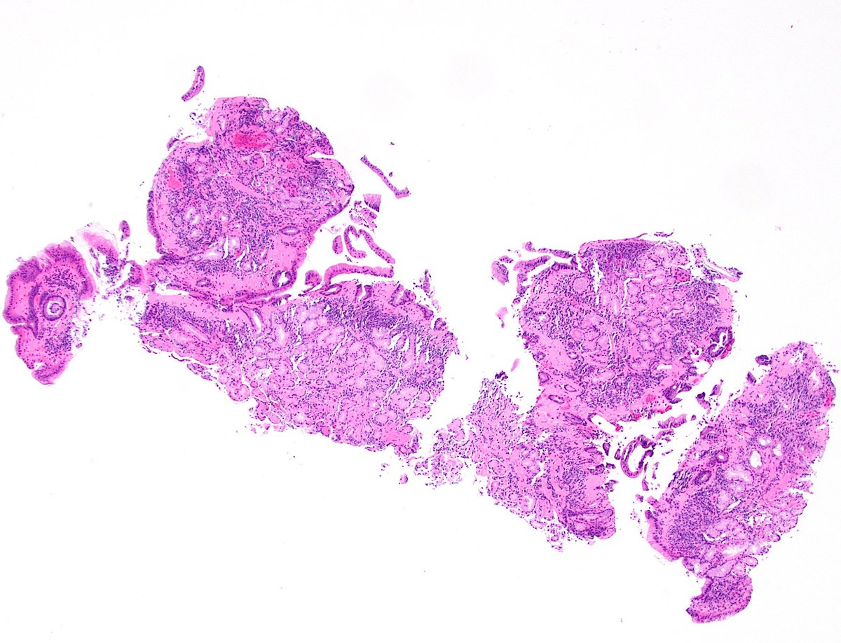 dgbrackett's tweet photo. 🟦Collagenous gastritis
🟦Trichrome stain highlights the thickened subepipthelial collagen w/ entrapped inflammatory cells &amp; capillaries
#GIpath https://t.co/cPGy598aZV
