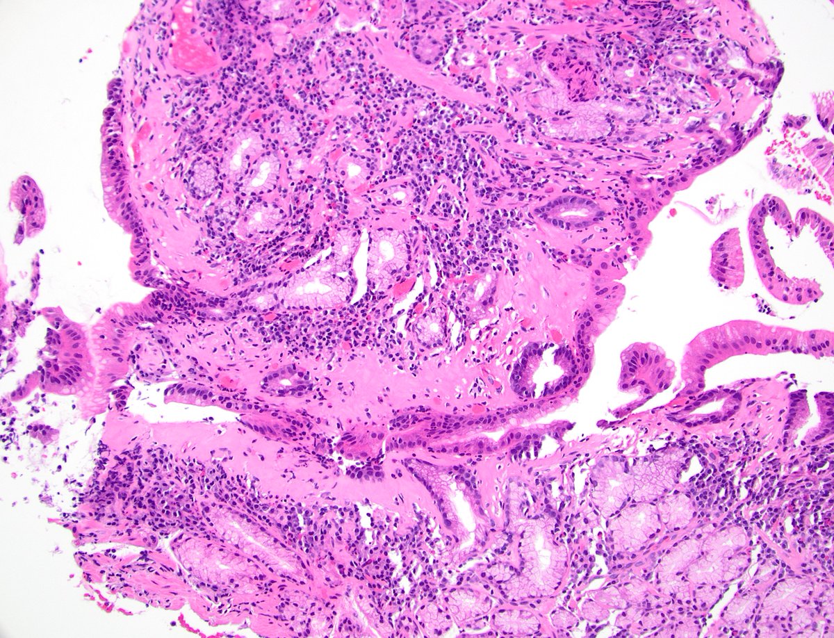 dgbrackett's tweet photo. 🟦Collagenous gastritis
🟦Trichrome stain highlights the thickened subepipthelial collagen w/ entrapped inflammatory cells &amp; capillaries
#GIpath https://t.co/cPGy598aZV