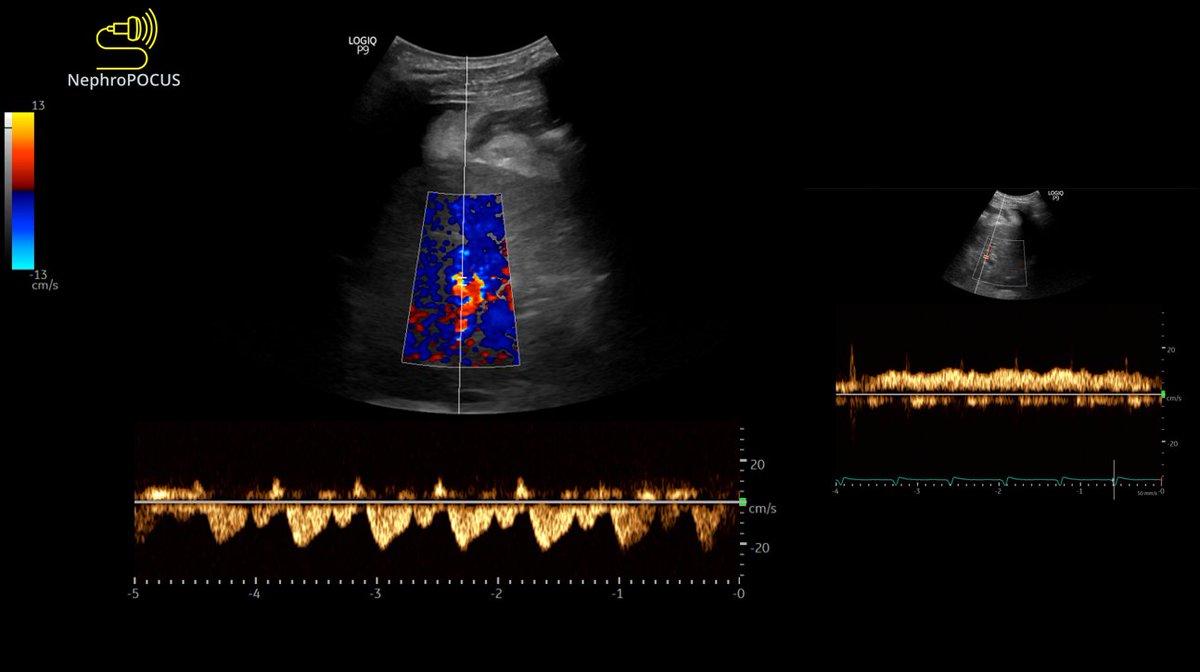 Interpretation of this hepatic vein #VExUS? Corresponding portal vein ...
