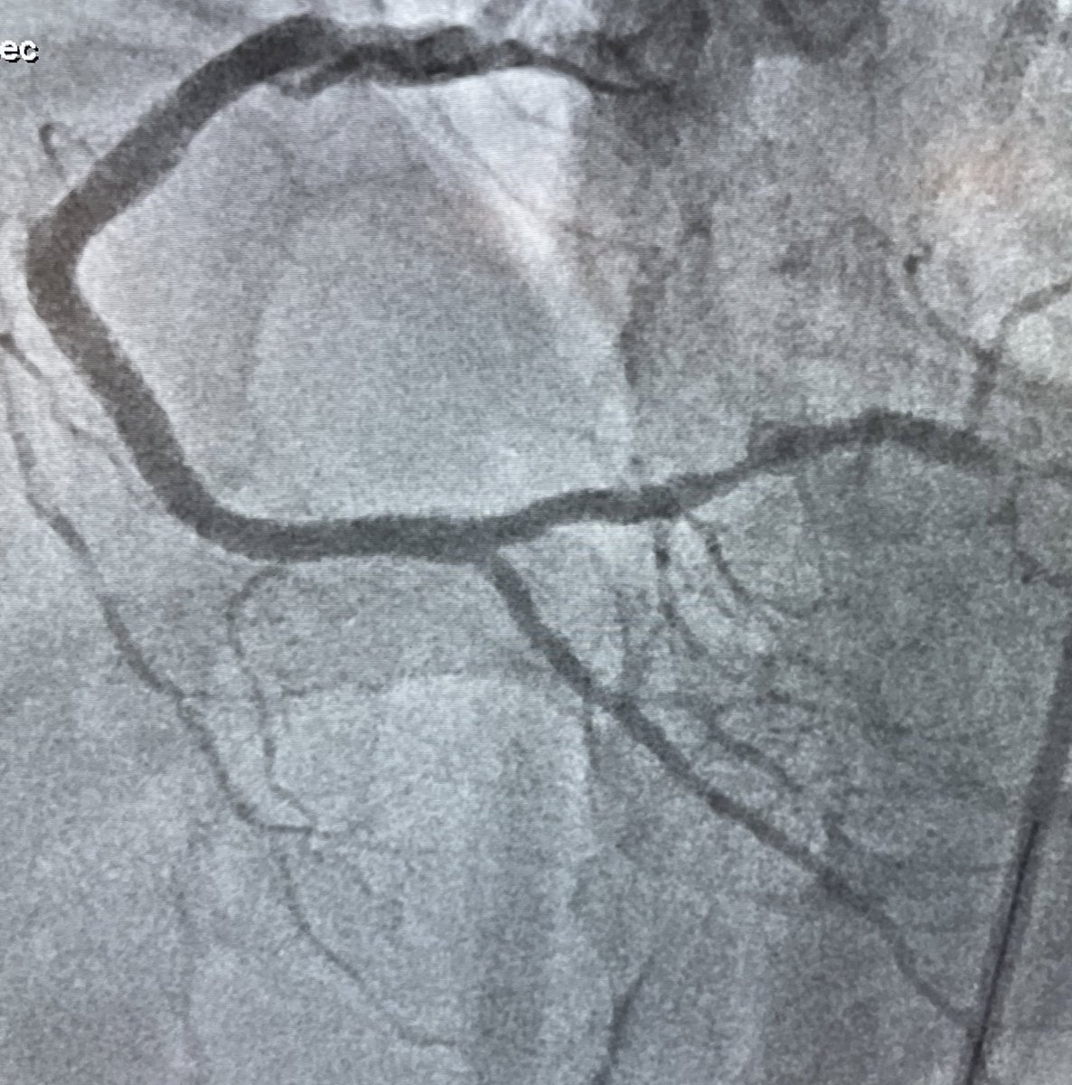 Joseph Yang (@jlyang5) on Twitter photo Historic moment <a href="/ZSFGCare/">Zuckerberg SF General Hospital & Trauma Center</a>: First ever Rotablator and Shockwave IVL coronary case with my friend and mentor #JohnMacGregor and <a href="/UCSF_CVfellows/">UCSF Cardiology Fellows</a> <a href="/LuisaCiuffo/">Luisa Ciuffo</a>! Historic moment <a href="/ZSFGCare/">Zuckerberg SF General Hospital & Trauma Center</a>: First ever Rotablator and Shockwave IVL coronary case with my friend and mentor #JohnMacGregor and <a href="/UCSF_CVfellows/">UCSF Cardiology Fellows</a> <a href="/LuisaCiuffo/">Luisa Ciuffo</a>!