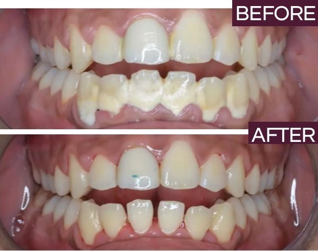 thetooth_dr's tweet photo. The before photo is of a patient with plaque buildup. The after photo was achieved with dental scaling and root planing. 

#flossdental #thetoothdr #flossboss #beforeandafter #cleaning #rootplaning #scaling #edgedentalhouston #dentist #dentistry #trinidadandtobago https://t.co/Z3StFCJ2Gi