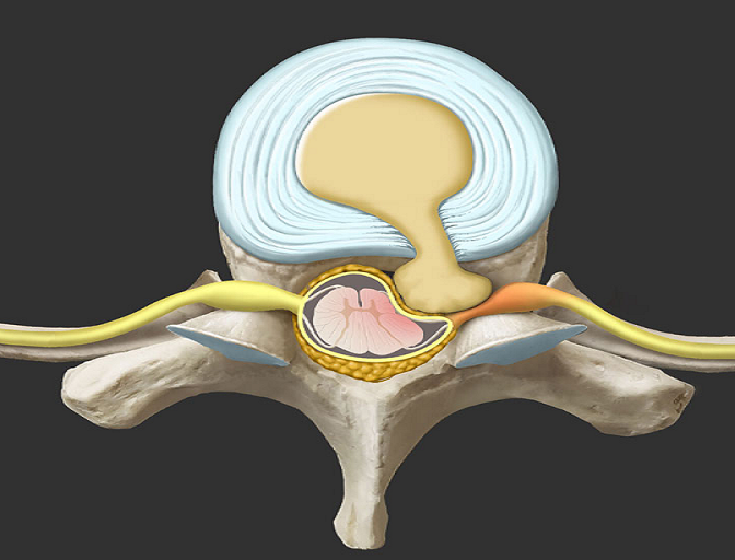 drdozellodc's tweet photo. Thoracic Spine Disc Herniation
Dr Donald A Ozello DC
#midbackpain #backpain #vegas #chiropractor #chiropractic #sportsmedicine #discherniation #discbulge #thoracicspine #midback #thoracicdisc #midbackdisc #thoracicpain #thoracicspinepain #ribcagepain https://t.co/I0ZEWscwiD https://t.co/nobH0VQafW