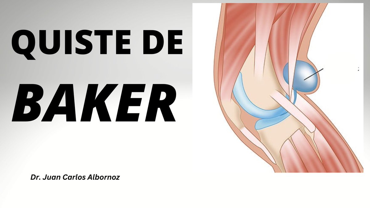 tutraumatologo's tweet photo. TODO LO QUE NO SABIAS DEL QUISTE DE BAKER
https://t.co/wzqjGrFdEJ #quistedebaker #4Enero #FelizMiercoles https://t.co/0aCqtYuFcc