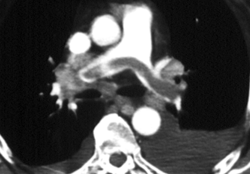 Classic classic CT finding. What is your diagnosis? #medtwitter #healthcare #radiology #meded #Medical #HemeTwitter #emergencymedicine #stat #pulmtwitter #MedicalStudents