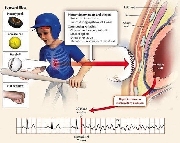 Commotio Cordis: Ventricular fibrillation and sudden death triggered by a blunt, non penetrating, and often innocent appearing unintentional blow to the chest without damage to the ribs, sternum, or heart <a href="/LITFLblog/">LITFL</a> #MedEd #Medtwitter #FOAMed tinyurl.com/3yb5a8ku
