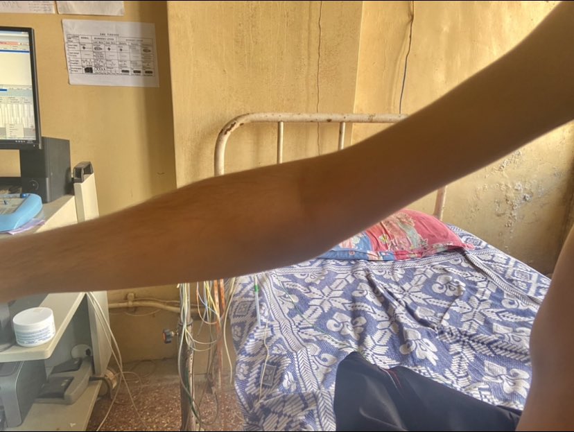 neurogenicpoet's tweet photo. POPEYE Arm! Seen in #Neurology clinic in patients with Facioscapulohumeral Dystrophy due to atrophy of arm and preserved forearm 

An odd #MuscularDystrophy since
- early face inv
- upper limb before lower 
-asymmetric 
- normal CPK

#MedEd #MedTwitter #NeuroTwitter https://t.co/dpwy0boe08