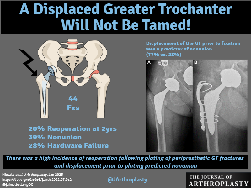 How do you tame the GT fracture? <a href="/womenAAHKS/">WomenInArthroplasty</a> @KevinWeiszMD <a href="/kimtuckinAZ/">Kim Tucker, MD, FAAHKS, FAAOS</a> <a href="/alexusmcooper/">Alexus M. Cooper, MD</a> <a href="/CenterRotation/">Brock Howell MD, FAAOS</a> <a href="/DrPeterGold/">Peter Gold MD</a> <a href="/BrdgPlt2Nowhere/">BridgePlate2Nowhere</a> <a href="/BrianChalmersMD/">Brian Chalmers</a> <a href="/HSpecialSurgery/">Hospital for Special Surgery (HSS)</a> 

arthroplastyjournal.org/article/S0883-…