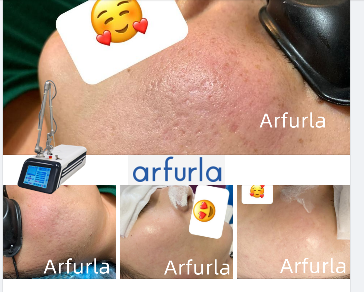 Jason_arfurla's tweet photo. CO2 skin rejuvenation, freckle removal, acne removal
Before and after comparison
#co2laser #co2laserresurfacing #co2fractional #CO2fractionallaser https://t.co/lnCqwlRHwO