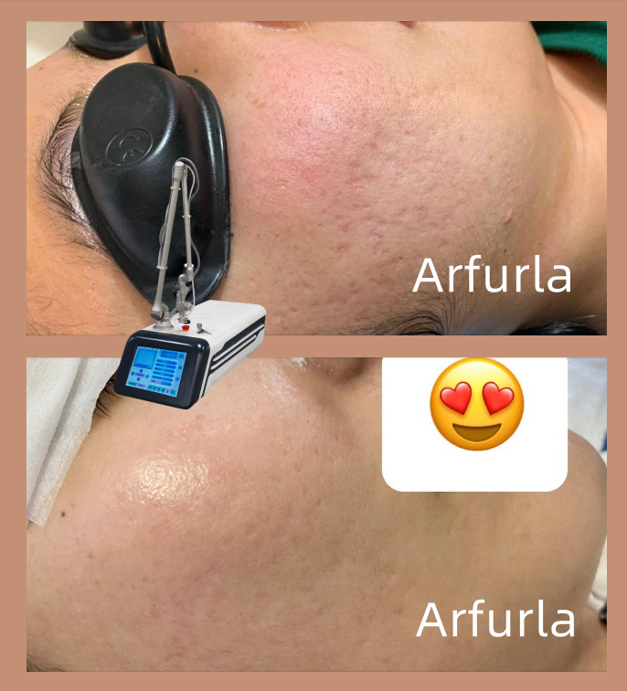 Jason_arfurla's tweet photo. CO2 skin rejuvenation, freckle removal, acne removal
Before and after comparison
#co2laser #co2laserresurfacing #co2fractional #CO2fractionallaser https://t.co/lnCqwlRHwO