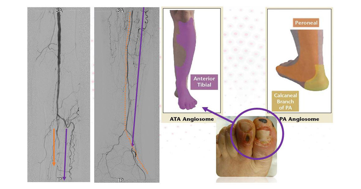 Paris Vascular Insights (ParisVascular) / Twitter