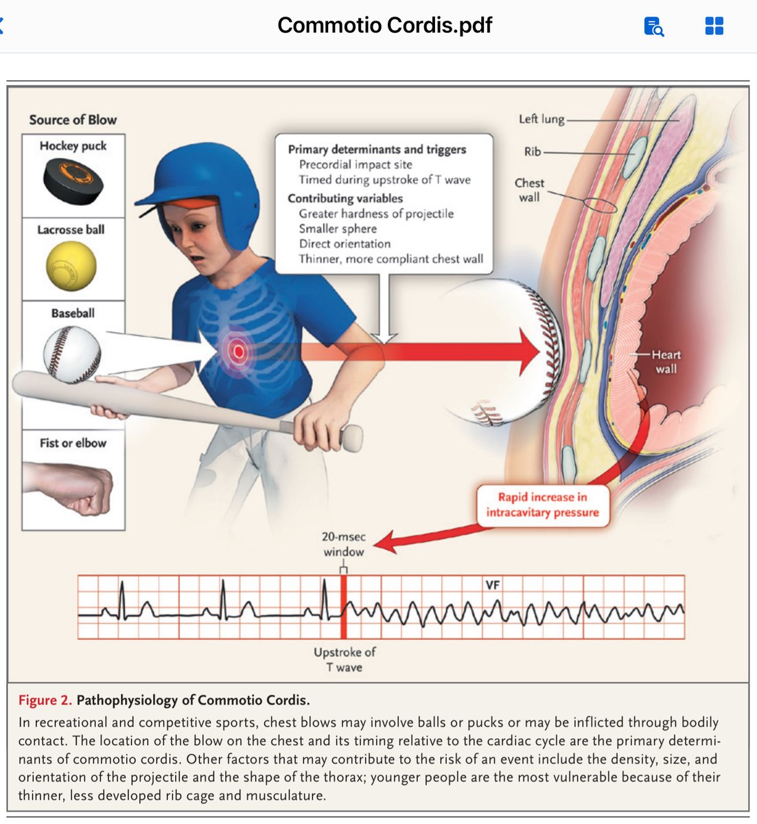 academiaer1's tweet photo. PCR en el Deporte #Commotio #Cordis #NFL #CPR #FOAMed https://t.co/YKTQhDzHXL
➡️ FV secundaria a un trauma directo en precordio ⏩️ Altera la estabilidad eléctrica ⚡️ del 🫀⏩️ FV
➡️ No contusión miocárdica @NEJM @relucho Biblio en el hilo 🧵 o escríbeme @academiaer1 https://t.co/3bZTBYZmZH