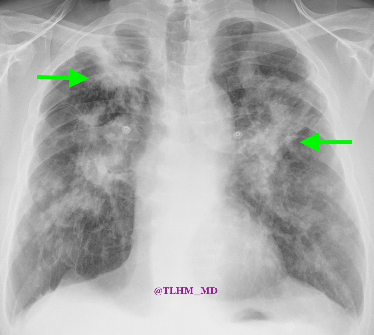 Metastatic disease, sarcoidosis, or multifocal pneumonia?  #meded #medtwitter #radtwitter #radiology #chestrad Submit in comments before checking out final report: ow.ly/9NKM50Mil35 (image: Dr. Tan-Lucien H. Mohammed, MD 
@TLHM_MD