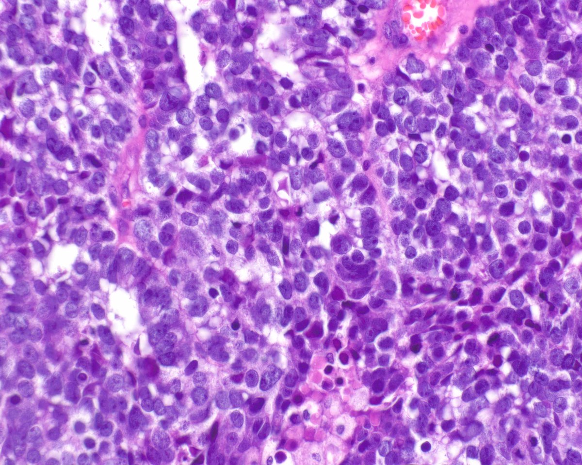 LizMontgomeryMD's tweet photo. Unusual abdominal adenocarcinoma showing "enteroblastic" differentiation.
Arora K, et al. Fetal-type gastrointestinal adenocarcinoma: a morphologically distinct entity with unfavourable prognosis. J Clin Pathol. 2018 Mar;71(3):221-227. PMID: 28814568. https://t.co/qT5LvVhjHm