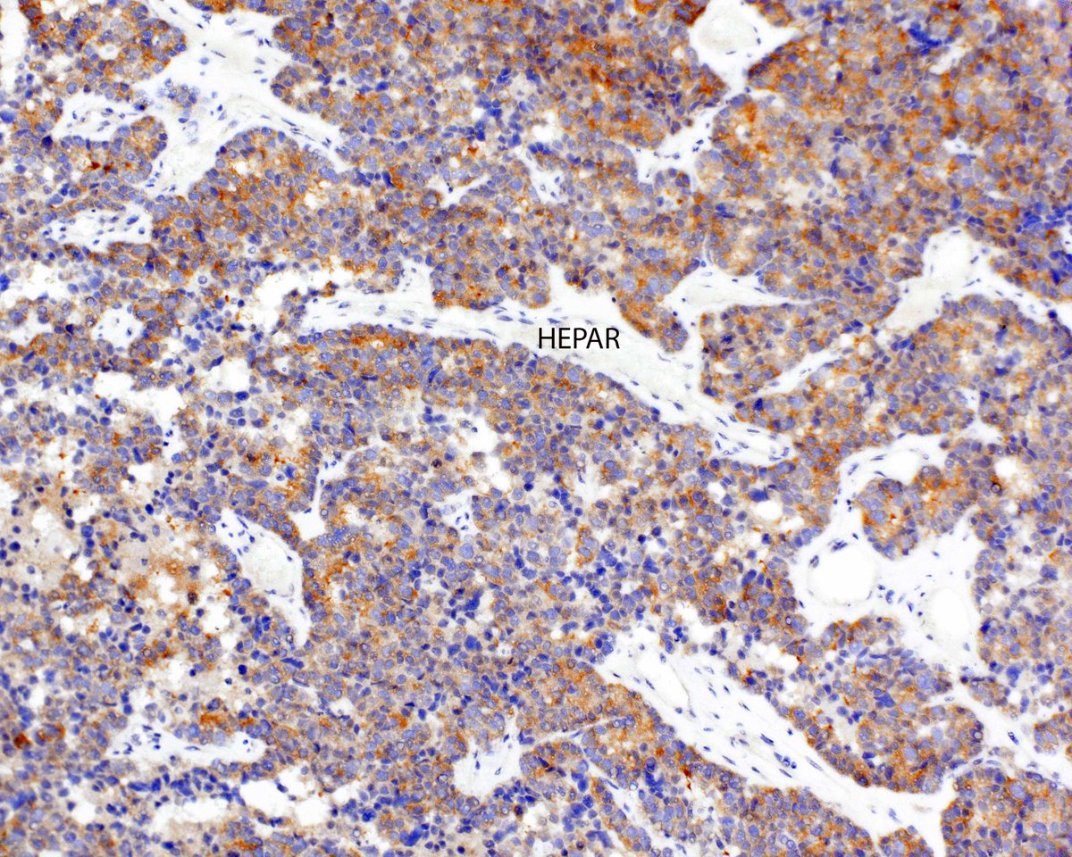 LizMontgomeryMD's tweet photo. Unusual abdominal adenocarcinoma showing "enteroblastic" differentiation.
Arora K, et al. Fetal-type gastrointestinal adenocarcinoma: a morphologically distinct entity with unfavourable prognosis. J Clin Pathol. 2018 Mar;71(3):221-227. PMID: 28814568. https://t.co/qT5LvVhjHm