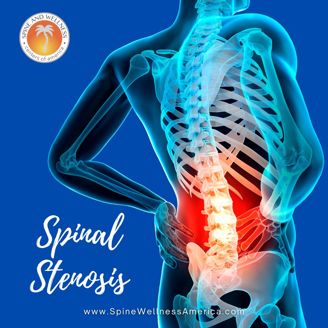 Our doctors at Spine and Wellness Centers of America treat spinal stenosis using Non-Surgical Treatments or Minimally Invasive pain relief techniques.

spinewellnessamerica.com

#paindoctor #SouthFlorida #painmanagement #pain #backpain #spinewellnessamerica #spinalstenosis