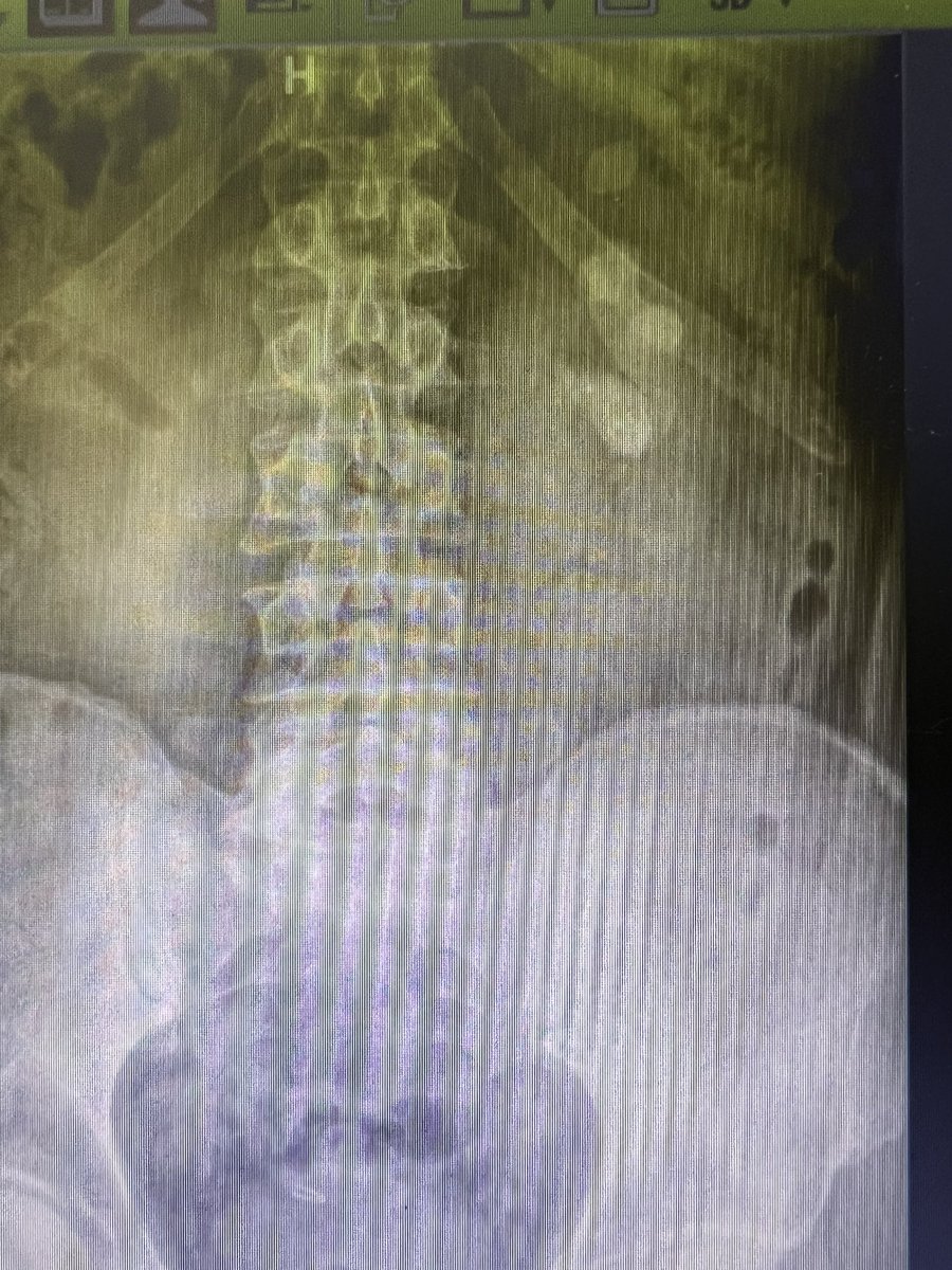 mdmancebo's tweet photo. Litotricia Percutanea Renal izquierda con doble abordaje y acceso intercostal de cáliz superior #UroSoMe #NLP #urology @FedeLopezFe @g3escobar https://t.co/NIJT37AyjK