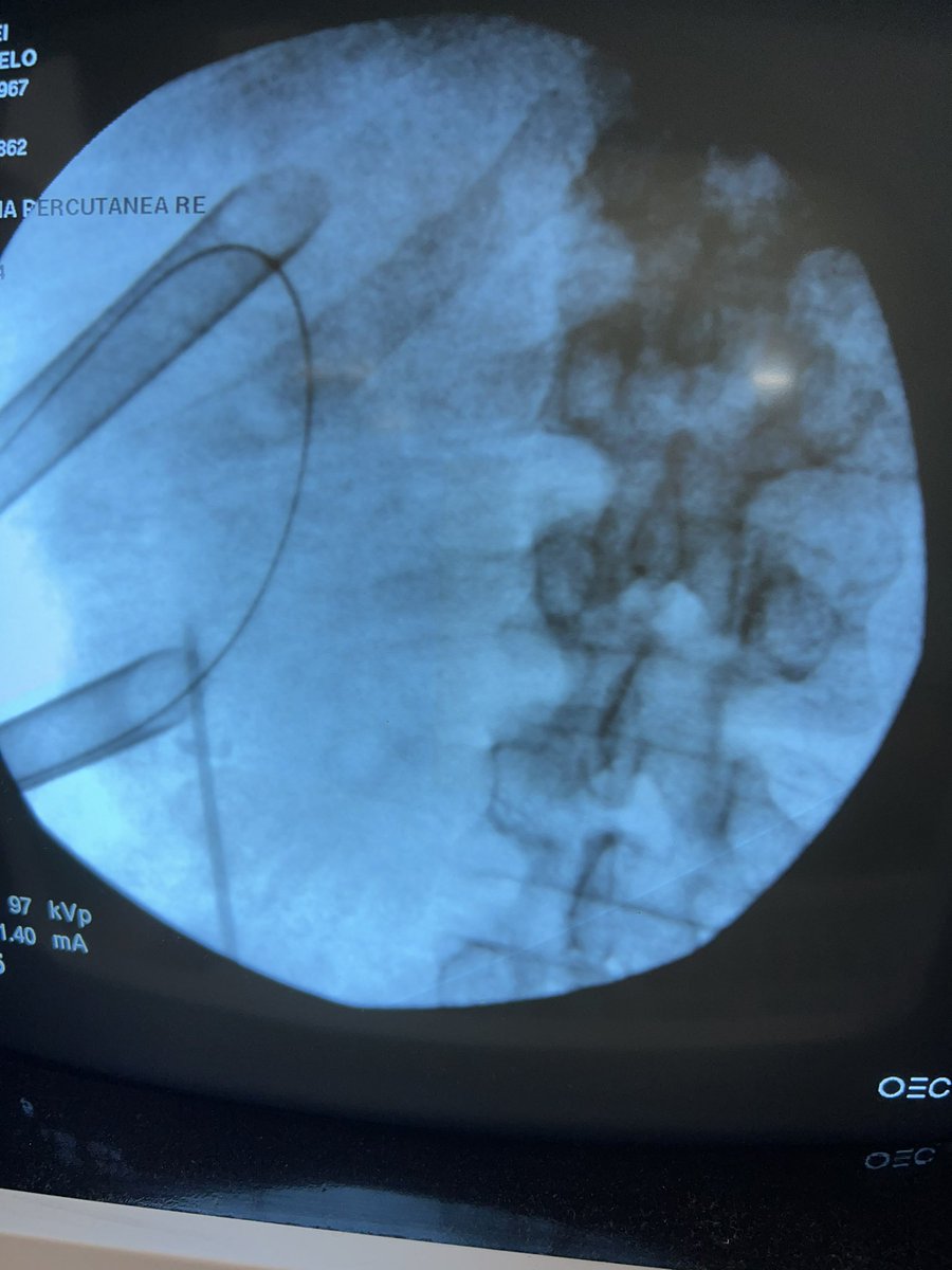 Matias Mancebo (@mdmancebo) on Twitter photo Litotricia Percutanea Renal izquierda con doble abordaje y acceso intercostal de cáliz superior #UroSoMe #NLP #urology <a href="/FedeLopezFe/">Federico López</a> <a href="/g3escobar/">Gustavo Escobar</a> Litotricia Percutanea Renal izquierda con doble abordaje y acceso intercostal de cáliz superior #UroSoMe #NLP #urology <a href="/FedeLopezFe/">Federico López</a> <a href="/g3escobar/">Gustavo Escobar</a>
