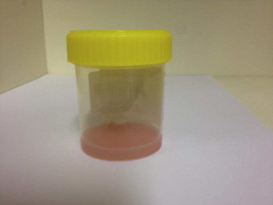GallodeMoraesMD's tweet photo. Case conference @MayoPCCM presented by @DavidSanbornMD (no pt identifier is included and pictures were cited from online resources) Pt comes to your clinic w/ dyspnea, pleural effusion, and Chyloptysis that looks like the picture below:
#casesofmayopccm 

https://t.co/aRBbdkWSvg https://t.co/SOorTSHWMV