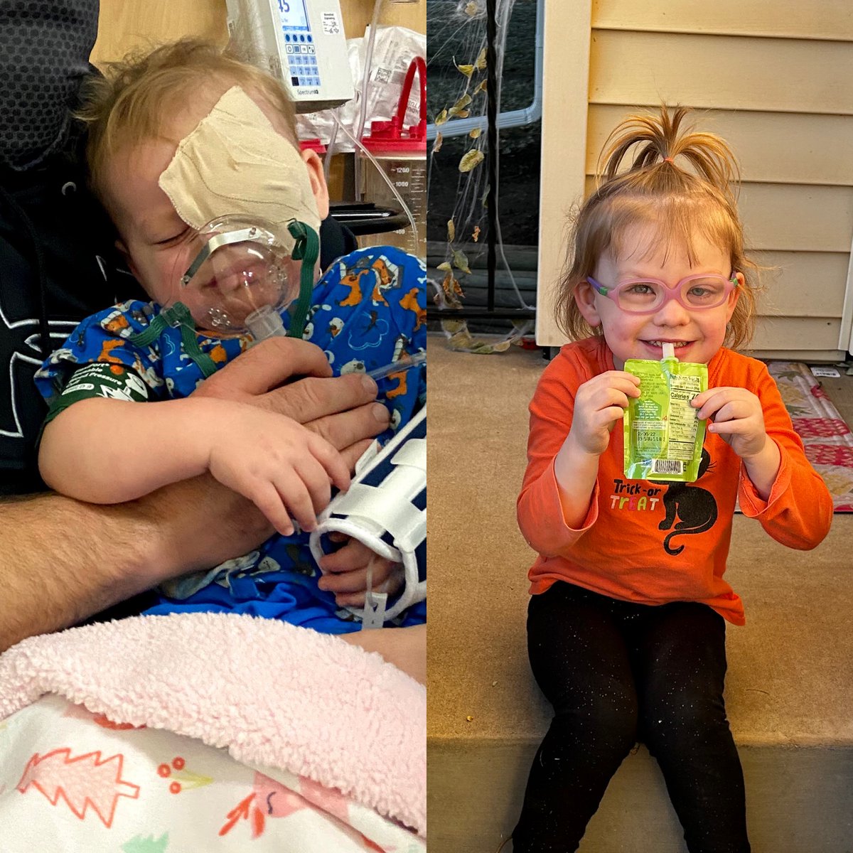 MHealthFairview's tweet photo. 4-year-old Hazel Farke is officially two years cancer-free. After having surgery with our experts for #retinoblastoma, a rare eye cancer, the toddler is now thriving. “Even though it was terrible, we’re so grateful,” said mom, Melisa. Read their story. ➡️ https://t.co/WAcT8j17lT https://t.co/TkGEKxiaXH
